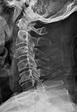 Spinous process fractures (C3-C5) | Radiology Case | Radiopaedia.org ...