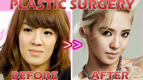 K Pops Plastic Surgery Influence On Teens And Young Adults Longevity