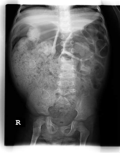 Ano Rectal Malformation Severe Rectal Dilatation Child Surgery Dr