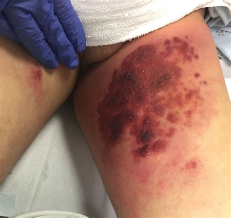 Series (similar things placed in order or happening one after another). Man with leg rash | Emergency Medicine Journal