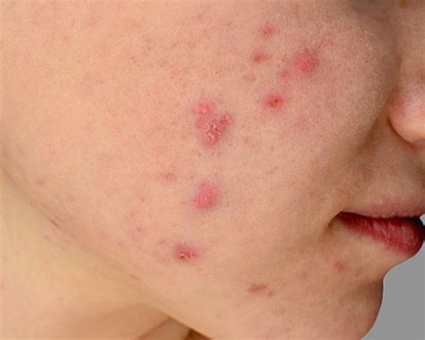 Top 10 Skin Disorders A Dermatologist Encounters Dermatology And