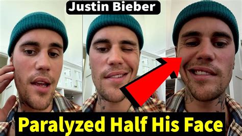 Justin Bieber Battling Pretty Serious Virus Thats Paralyzed Half His