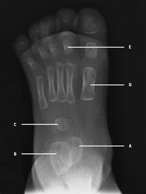 Radiograph Of The Left Foot Of A 7 Month Old Infant The Bmj