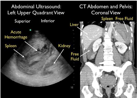 Splenic Rupture Diagnosed With Bedside Ultrasound In A Patient With