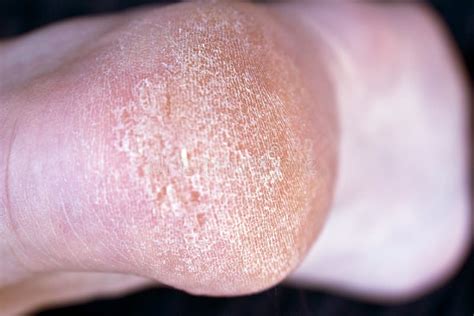 Dry Skin On The Feet Stock Image Image Of Care Background 190073025