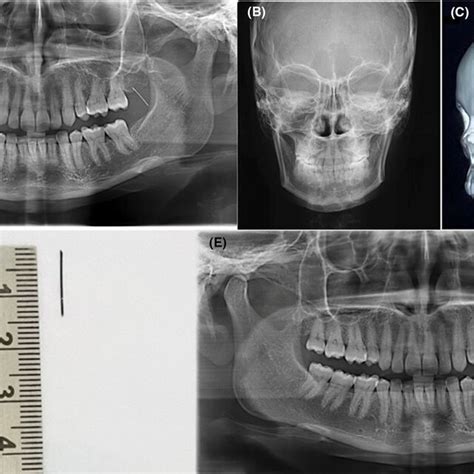Preoperative Panoramic Radiograph A Posteroanterior Skull View