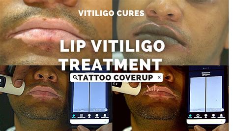 Lip Vitiligo Tattoo Coverup Safed Daag Lips Treatment Lip Vitiligo