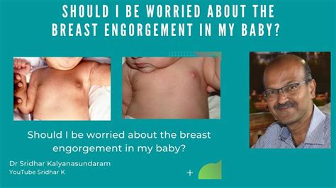 Should I Be Worried About The Breast Engorgement In My Baby Neonatal Mastitis