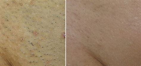 Before And After Laser Hair Removal Bikini Fitoont