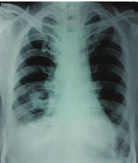 Chest X Ray Showing Bilateral Minimal Pleural Effusion And A