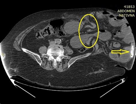 Figure 2 From Incarcerated Multiple Recurrent Inguinal Hernia With