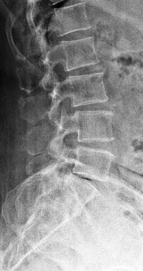 Normal Human Spine X Ray