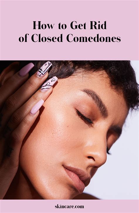 What are closed comedones and what causes them? How to Get Rid of Closed Comedones or Whiteheads in 2020 ...