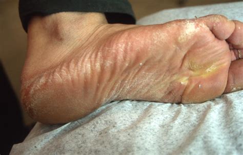 Superficial Fungal Infections Tinea Pedis Athlets Foot Picture