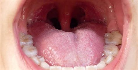 Can Tonsils Grow Back After Being Removed Tymoff A Comprehensive