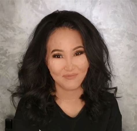 Woman Born With Moles All Over Her Face Is Transformed Into An