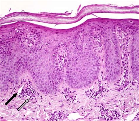 Histology Of Psoriasis Staining Of A Psoriasis Tissue Section By
