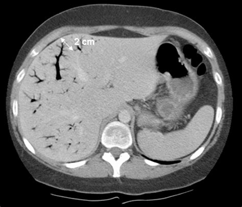 Computed Tomography Scan Of Patient 1 With Hepatic Portal Venous Gas
