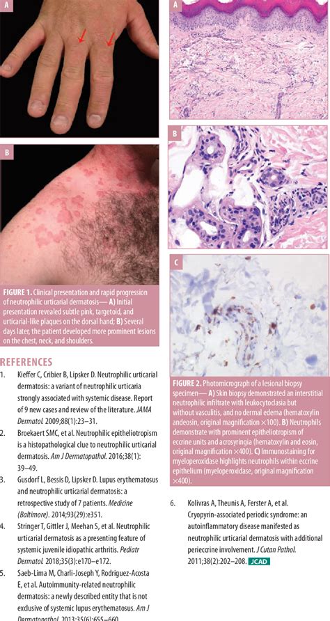 Figure 1 From Neutrophilic Urticarial Dermatosis Without Underlying