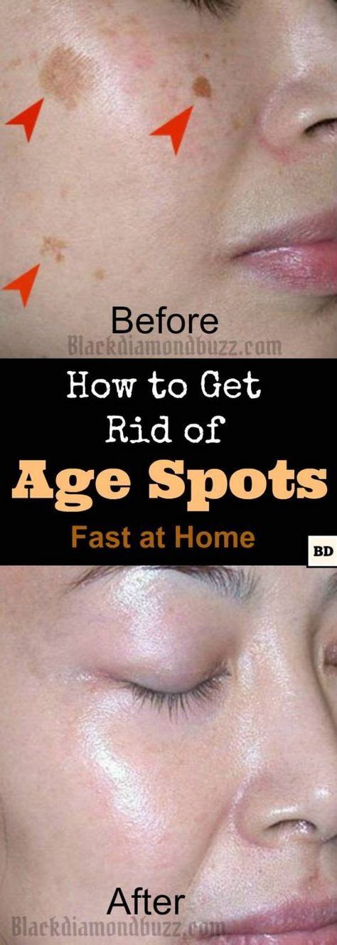 How To Get Rid Of Age Spots On Face 7 Home Remedies That Work Fast