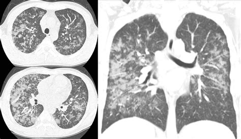 Pneumocystis Jirovecii Pneumonia Radiology Q Radiology