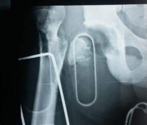 Cureus Traumatic Open Anterior Hip Dislocation In An Adult Male A