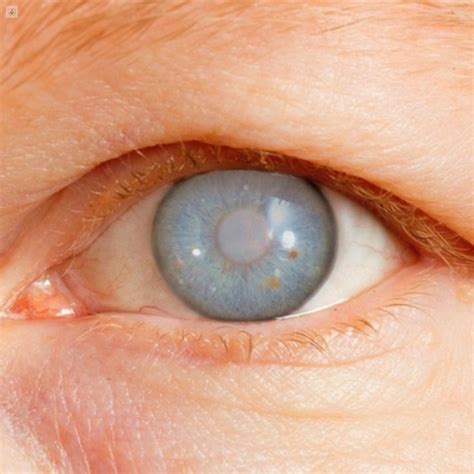Glaucoma Excavacion Nervio Optico Astigmatism Glaucoma Swollen Eyes