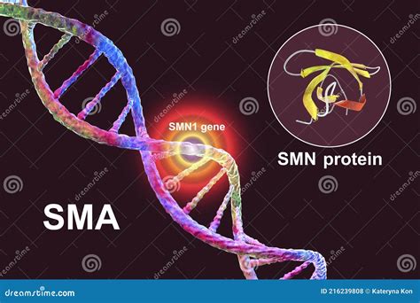 Spinal Muscular Atrophy Sma A Genetic Neuromuscular Disorder With