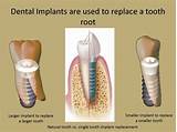 Photos of Emergency Dental Implants
