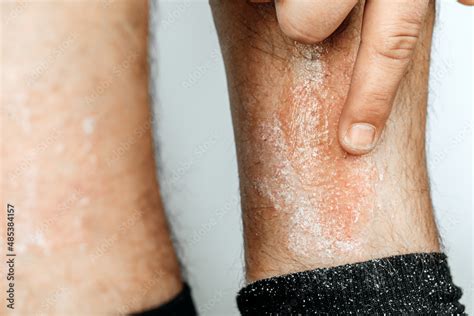 Acute Psoriasis Na Is An Autoimmune Incurable Dermatological Skin