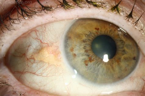 Pinguecula And Pterygium Whats The Difference Isight Vision Care