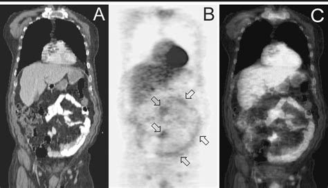 Coronal Images In A 57 Year Old Man After Ingestion Of Barium A Ct