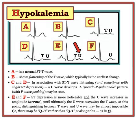Ecg Ekg Changes In Hypokalemia And Hyperkalemia Ecg Should Be Done On