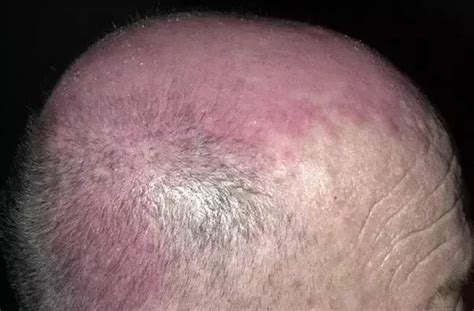 How To Treat Hives On Your Scalp Quora