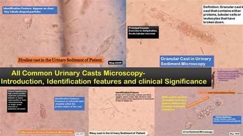 Common Urinary Casts Introduction Identification Features Normal Ran