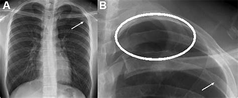 Visible Apical Blebs On Cxr Are Plain Radiographs Under Utilized In