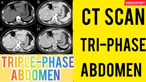 Live What Is Ct Triple Phase Wholeabdomen Triphasé Cttriplephase