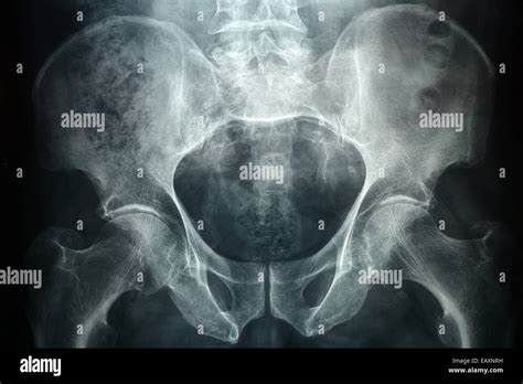 Xray Of A Male Pelvic Its A High Resolution 24 Mp Photo Not A Scan