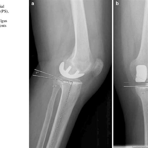 Post Operative Radiographs Showing A Tibial Component Posterior Slope