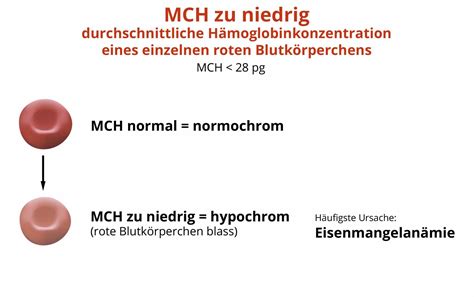 Mcv and mch are the part of the complete hemogram that indicates that the cell size especially the red blood cell size, that mean corpuscular hemoglobin. MCH zu niedrig