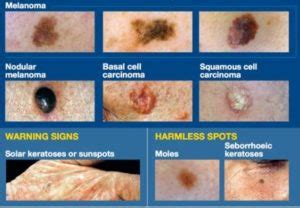 Small blisters are also called vesicles. Mole and wart removal with Cryopen | Wembley Clinic