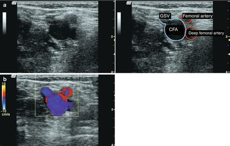 Examination Of The Great Saphenous Vein Radiology Key