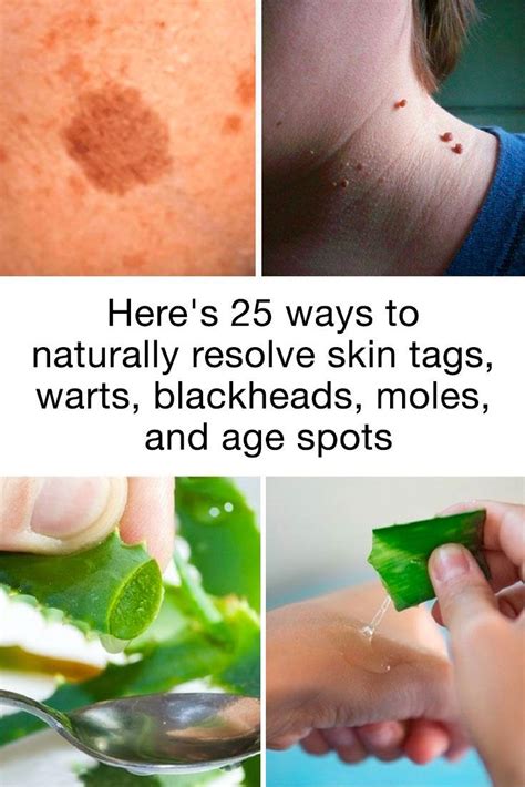 Naturally Resolve Skin Tags Warts Blackheads And Age Spots With