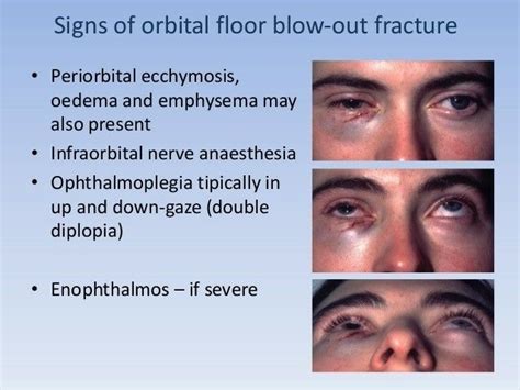 Note Enopthalmos May Occur In Traumatic Blowout Fracture Of Floor Of