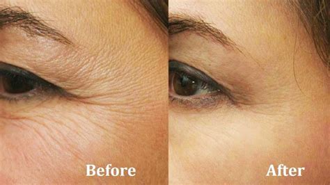 Best Treatment For Under Eye Wrinkles 2022 Consumer Reports