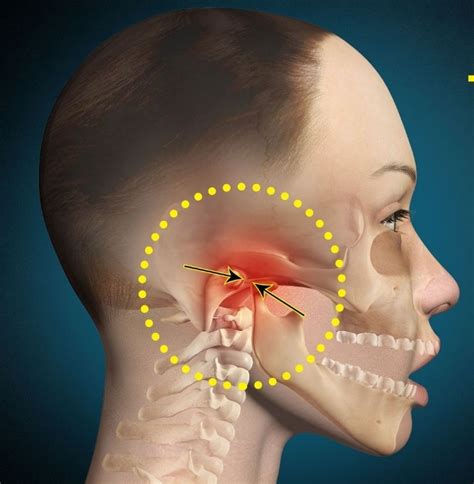 Five Signs That Suggest You Have Temporomandibular Disorder TMD StraightSmile Braces
