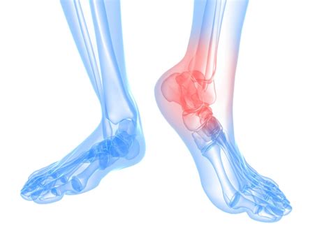 If you are suffering from foot pain contact one of our jacksonville podiatrists today. Heel Pain - Georgetown, ON Foot Doctor