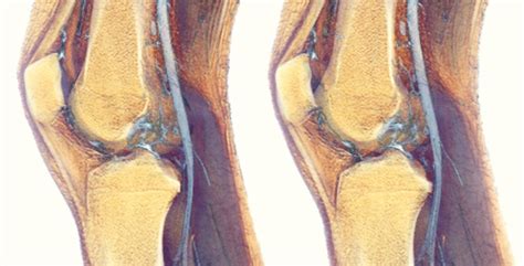 Knee Synovitis Volume Rendering Of An Mri Scan Of The Kn Flickr