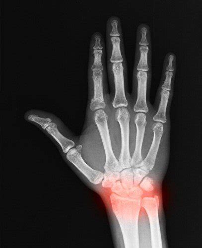 Diagnosis Carpal Tunnel Surgery Clinic