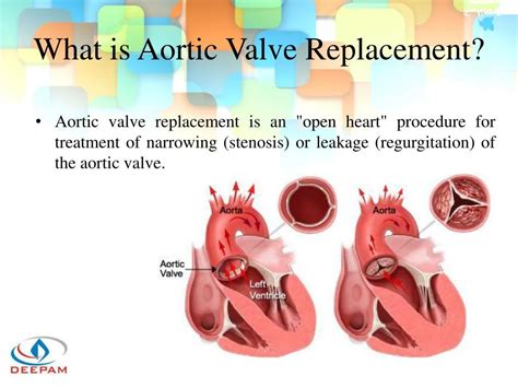 Ppt Avr Mvr All You Need To Know About Valve Repair And Replacement